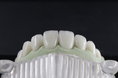 Sứ Zirconia đa lớp