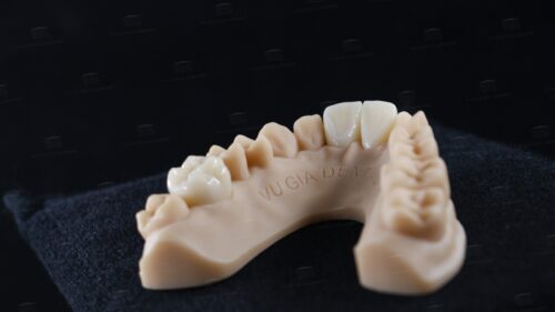 Sứ Zirconia nguyên khối